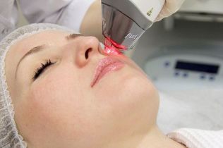 Process of rejuvenating the skin of the face with a fractional laser