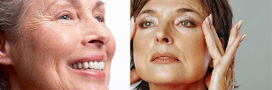 Mimic wrinkles and age-related changes