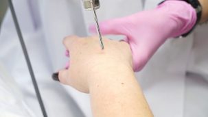 Laser rejuvenation of the hand skin